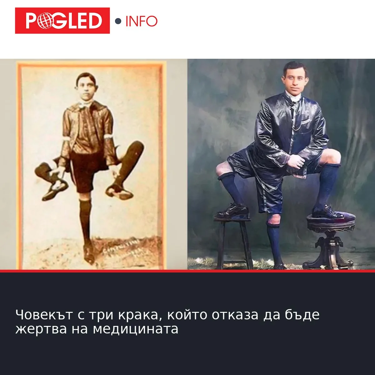 Човекът с три крака, който отказа да бъде жертва на медицината